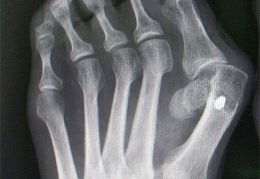 X-RAY