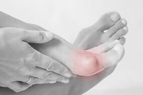 Hallux valgus comment choisir des chaussures