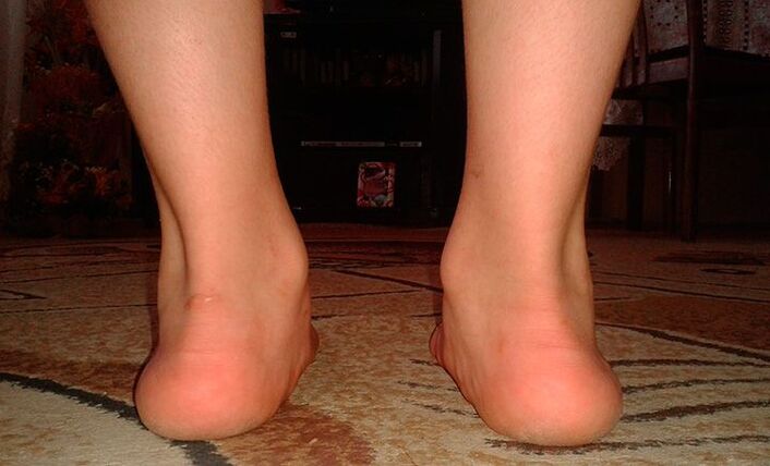 Pieds plats en valgus