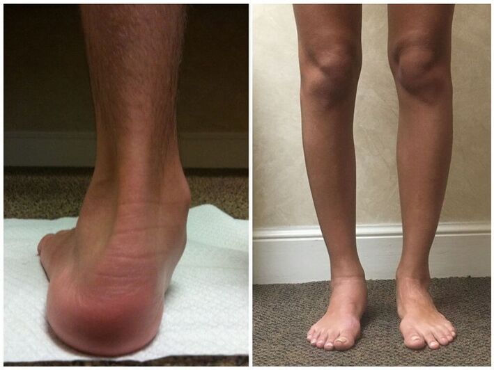 Jambes avec hallux valgus