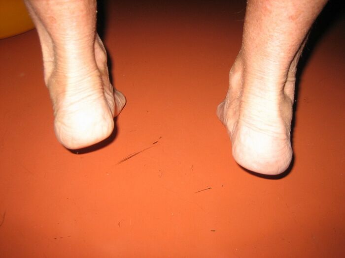Marcher sur la pointe des pieds pour renforcer les pieds souffrant d'hallux valgus