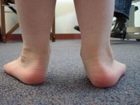Valgus du pied plat chez un enfant