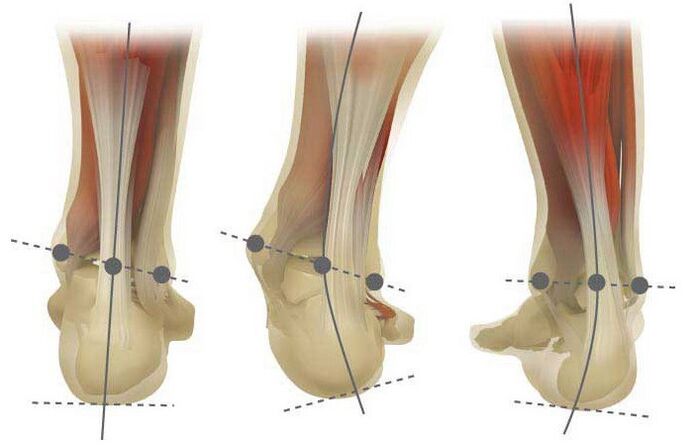 Types Valgo