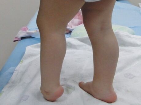 Les premiers symptômes de la déformation des pieds